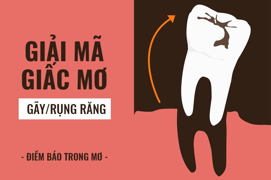 VNSOXO – Giải Mã Mơ Thấy Gãy Răng: Điềm Lành Hay Dữ?